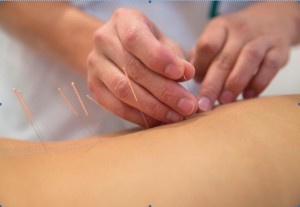acupuncture for backpain