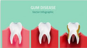 gum disease