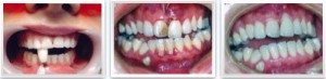 bleeding gum treatment