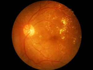 diabetic retinopathy